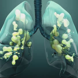 Immagine di polmoni umani con il liquido accumulato dentro